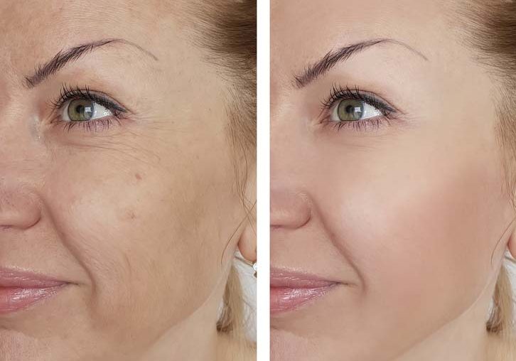 Face girl wrinkle before and after cosmetic procedures correction effect lifting